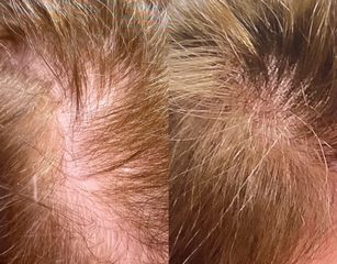 Before and after hair restoration