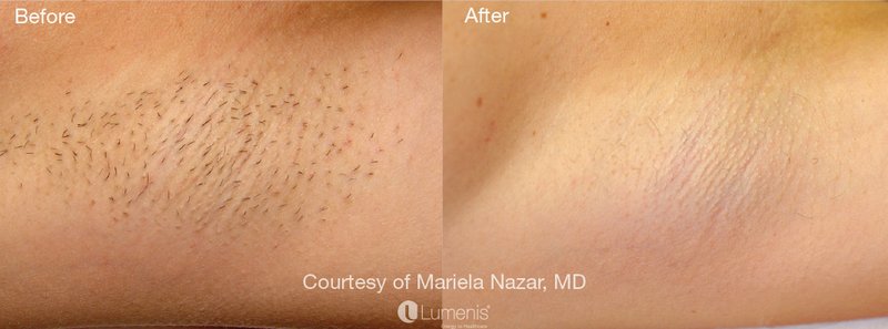 laser hair removal before and after 1