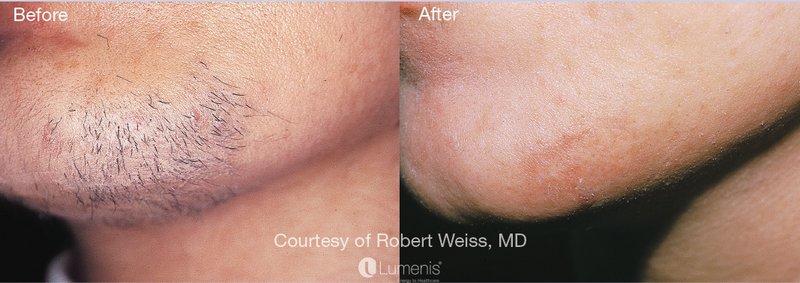 laser hair removal before and after 2