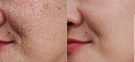 laser treatment for vascular and pigmented lesions before and after photo 1