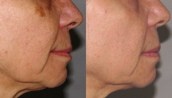 laser treatment for vascular and pigmented lesions before and after photo 2