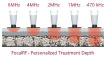 nuera focalrf technogy