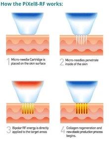 PiXel8-RF-how-micro-needling-works