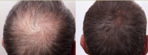 hair restoration before and after